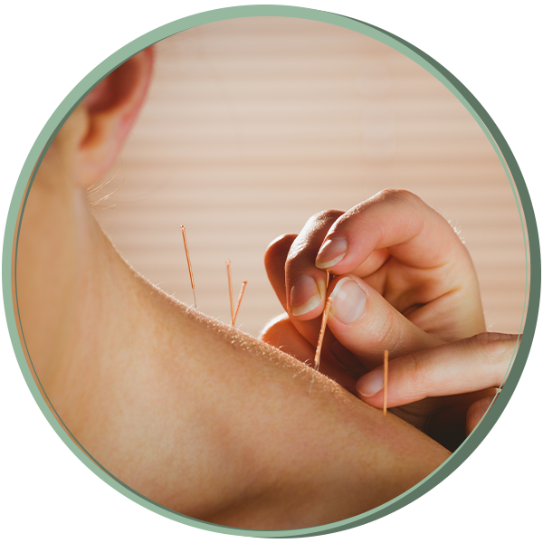 acupuncture