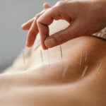 close up of acupuncture needles on a person's lower back